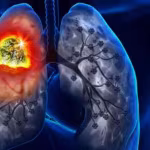سرطان الرئة… الأرقام مقلقة