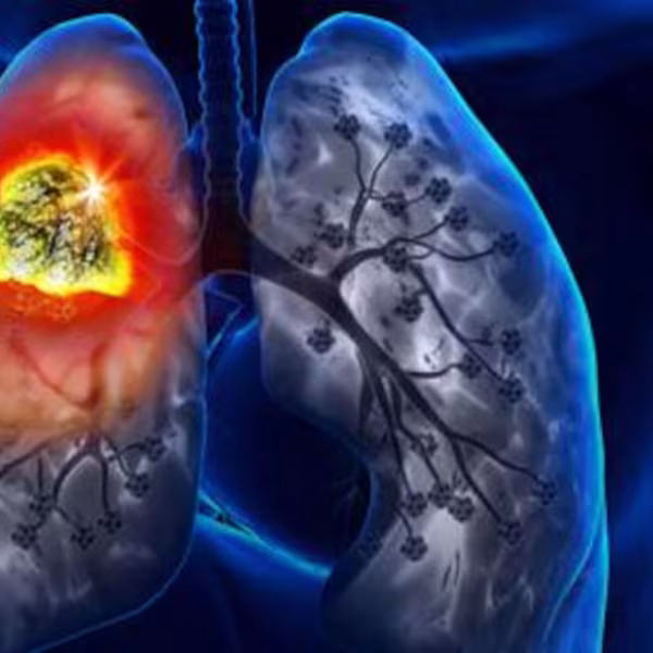 سرطان الرئة… الأرقام مقلقة
