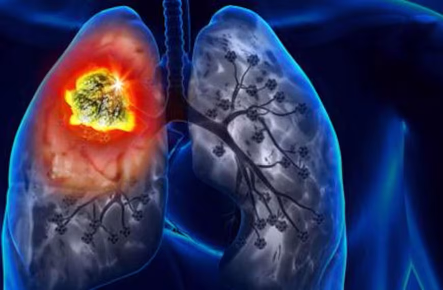 سرطان الرئة… الأرقام مقلقة